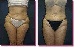 Liposuction Before and After