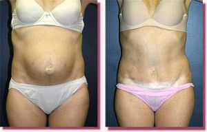 Abdominoplasty Before and After