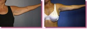 Brachioplasty Before and After