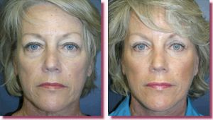 Facelift Before and After